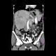 Liver metastases, carcinoid: CT - Computed tomography
